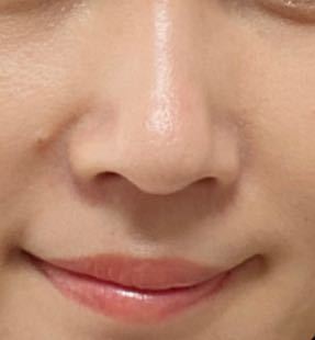 鼻の整形について 私はだんご鼻で かつ横幅が広いのがコンプレックスで Yahoo 知恵袋