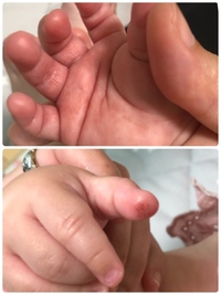 指しゃぶりで 手荒れしてます 1才の子なんですが 眠い時等に左手の Yahoo 知恵袋