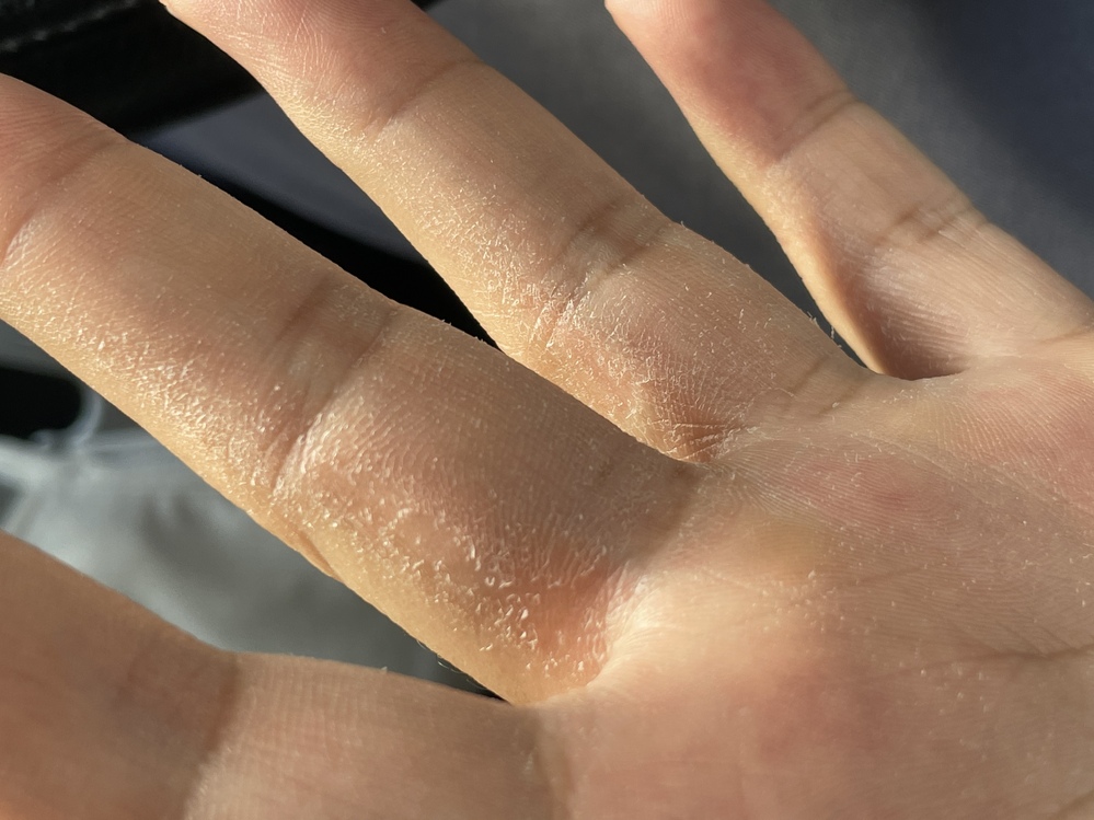 皮膚の病気 アトピー 回答受付中の質問 Yahoo 知恵袋