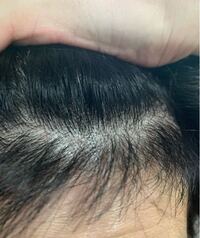 前髪を上にあげると地肌がみえるんですがこれ禿げてきてますか Yahoo 知恵袋