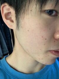 女子の方に聞きたいです 最近ニキビに悩んでいるのですが Yahoo 知恵袋
