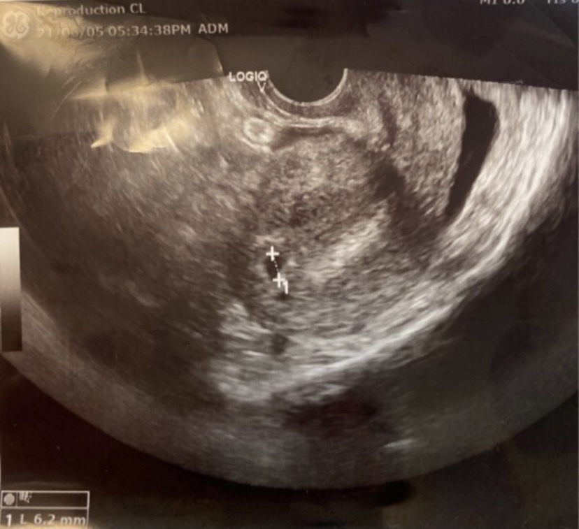 本日4w6dです胎嚢確認 6mm 出来ましたが卵巣が40mmに Yahoo 知恵袋