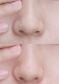 整形で下のように小鼻の幅を狭めることは出来ますか 小鼻が厚いの Yahoo 知恵袋