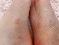 足の裏や足回りの赤みとかゆみについて これは水虫でしょうか ダニ あ Yahoo 知恵袋