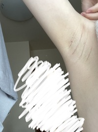 画像注意 高2女子です わたしはとても脇が汚いです ブツブツだし 変にシ Yahoo 知恵袋