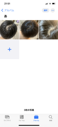 つむじが２つあるのですがつむじ禿げですか それともシンプルに禿げているん Yahoo 知恵袋