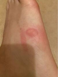 画像あり 足の甲がとても痒く 見てみたら蚊に刺されたときよりもすごく腫 Yahoo 知恵袋