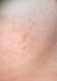 胸の発疹について 胸の横の方に発疹ができていて なかなか治 Yahoo 知恵袋