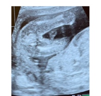 このエコー写真から性別分かりますか ちなみに妊娠16週です 女の子 Yahoo 知恵袋