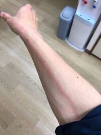 これはリンパ管炎ですか 昨夜から特に悪化しています 腋から母指にか Yahoo 知恵袋