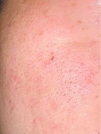 頬の毛穴についてです 広がった毛穴を目立たなくする方法を教えてくだ Yahoo 知恵袋