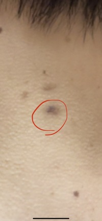大学生です 元々 遺伝でホクロが多い体質です 半年前から首にあるホ Yahoo 知恵袋