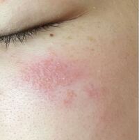 乾燥性皮膚炎ですか 前から1部だけかさついていたのですが 最近触っ Yahoo 知恵袋