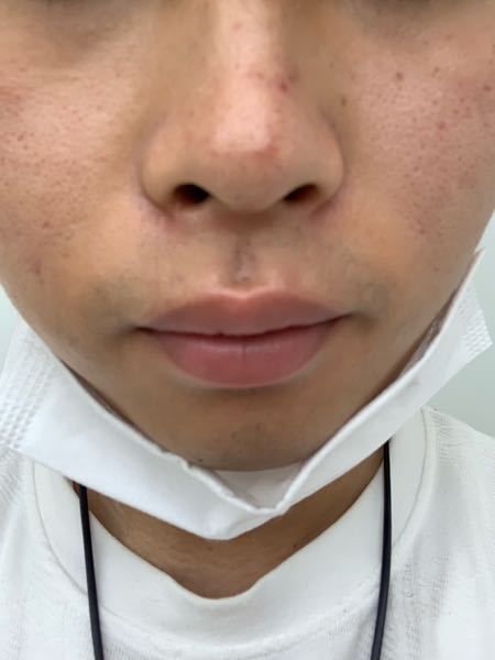 遺伝のそばかすを消す方法はありますか 自分でクリームやサプリを調べてみた Yahoo 知恵袋