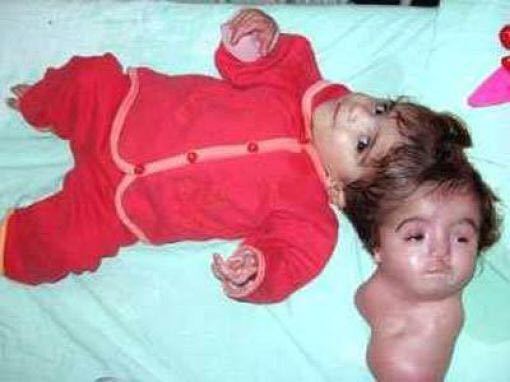 結合双生児について質問します 二人の赤ちゃんが体のどこかで繋が Yahoo 知恵袋