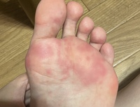 足の裏に痒みのある赤い斑点画像閲覧注意です 外出してたくさん歩いた Yahoo 知恵袋