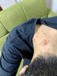 首が痒いんですがダニでしょうか 美容院にいってパーマをしたのでパーマ液で Yahoo 知恵袋