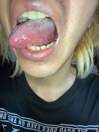 舌の横側に白い筋みたいな線が出来てるんですがこれは白板症とかで Yahoo 知恵袋