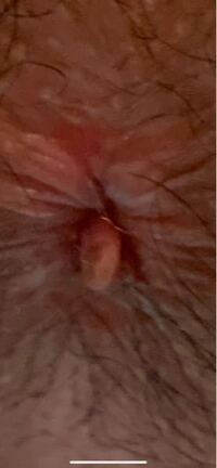 これっていぼ痔でしょうかまた直し方など教えてください 汚らしくすいません Yahoo 知恵袋