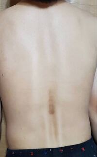 高3男子です 背中に黒いあざのようなものがいつのまにか出現してたのですが Yahoo 知恵袋