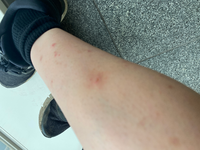 足のぶつぶつがなくなりません なくなったとしても茶色く跡が残ってしまい Yahoo 知恵袋