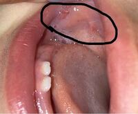 突発性発疹と麻疹の違い 発熱から3日目に解熱と発疹 夜に Yahoo 知恵袋