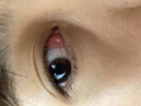 目頭の中 涙丘 が腫れています 痛いし痒かったのでコンタクト外してアイボ Yahoo 知恵袋