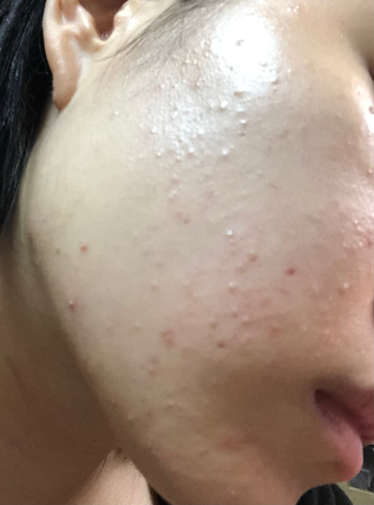突然頬に白いブツブツしたものができていることに気付きました こ Yahoo 知恵袋