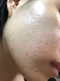 突然頬に白いブツブツしたものができていることに気付きました こ Yahoo 知恵袋