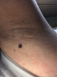 画像あり注意 乳首の名残が脇の下にあります 副乳という物みた Yahoo 知恵袋