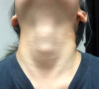 至急 写真あり 10代後半の女です 半日ほど前から喉仏の下を触 Yahoo 知恵袋