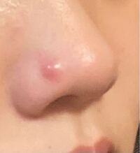 この大きなニキビってどれくらいで治るでしょうか 早くニキビ Yahoo 知恵袋