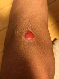 １ヶ月ほど前に膝にできた擦り傷の傷口が下の写真のようにぷにぷに Yahoo 知恵袋