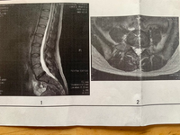 二ヶ月ほど前から腰の痛みと左足に痺れがあり 先日mriを受けたところ 椎 Yahoo 知恵袋