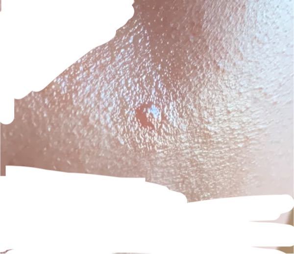 ほくろを取って3週間経ちました。 - これは肥厚性瘢痕でしょうか 