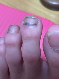 足の人差し指が黒いんですけど これってなんかの病気ですか 陸 Yahoo 知恵袋