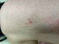 太ももに赤い斑点が出来ていたのですが これはダニに刺された跡でしょうか Yahoo 知恵袋