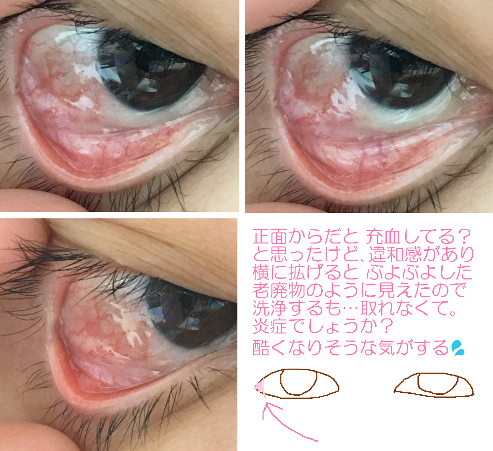 閲覧注意 目に異常がでました鏡を見た際 右目が赤く感じてはい Yahoo 知恵袋