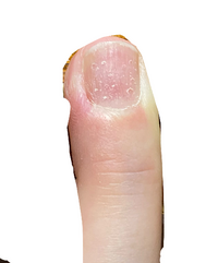 爪のボコボコ穴について写真の通り 右手の薬指の爪だけボコボコと Yahoo 知恵袋