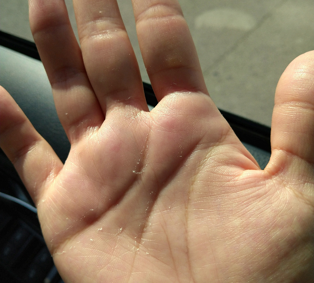 皮膚の病気 アトピー 解決済みの質問 Yahoo 知恵袋