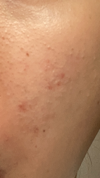 最近急に頬に大量のブツブツが出来てしまったのですが これは牌粒腫なのでし Yahoo 知恵袋