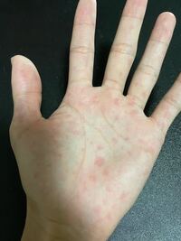 画像のような急に手のひらに赤い斑点模様が出てきました これはな Yahoo 知恵袋