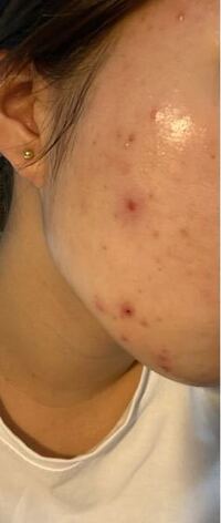 閲覧注意です 元々ニキビなんてない肌だったのにここ2週間 Yahoo 知恵袋