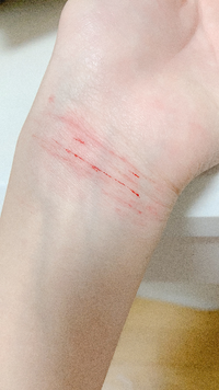 中1です リストカットをしてしまったのですが 傷はまだ浅いです このぐら Yahoo 知恵袋