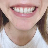 ガミースマイル 全力で笑うとこれくらい普通に歯茎が出るん Yahoo 知恵袋