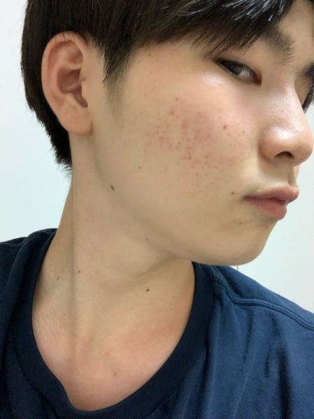 僕は彼女に隠していることがあります それは顔にニキビ跡が大量にある Yahoo 知恵袋