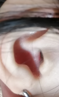 一ヶ月以上前から耳の入り口あたりが痛む事があって病院に言っても掻かなかっ Yahoo 知恵袋