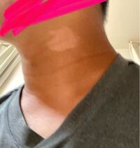 首に白いシミみたいなのが出来ました 原因わかる人いたらお願いしたます Yahoo 知恵袋