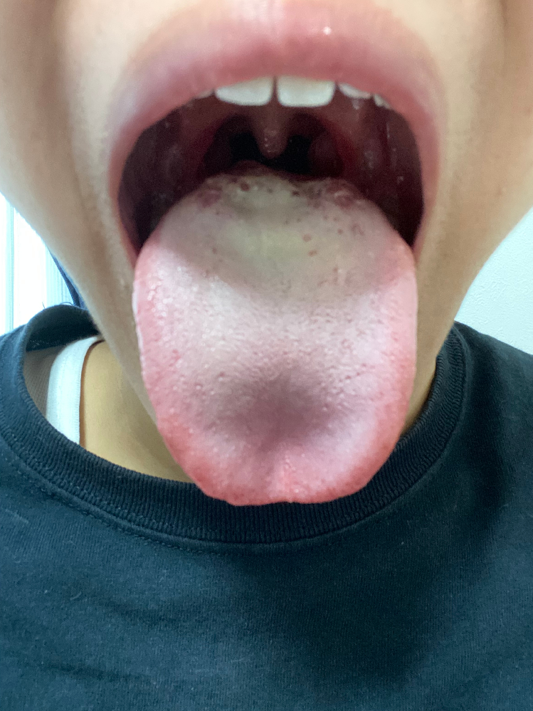 この舌苔はなんですかね同じもの食べてるのに付きます舌磨きは昨日からやめま Yahoo 知恵袋