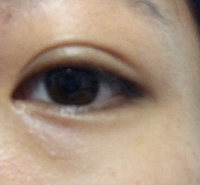 7月に3点どめの埋没をしたのですが 目尻側の糸が緩んでいるのでしょうか Yahoo 知恵袋